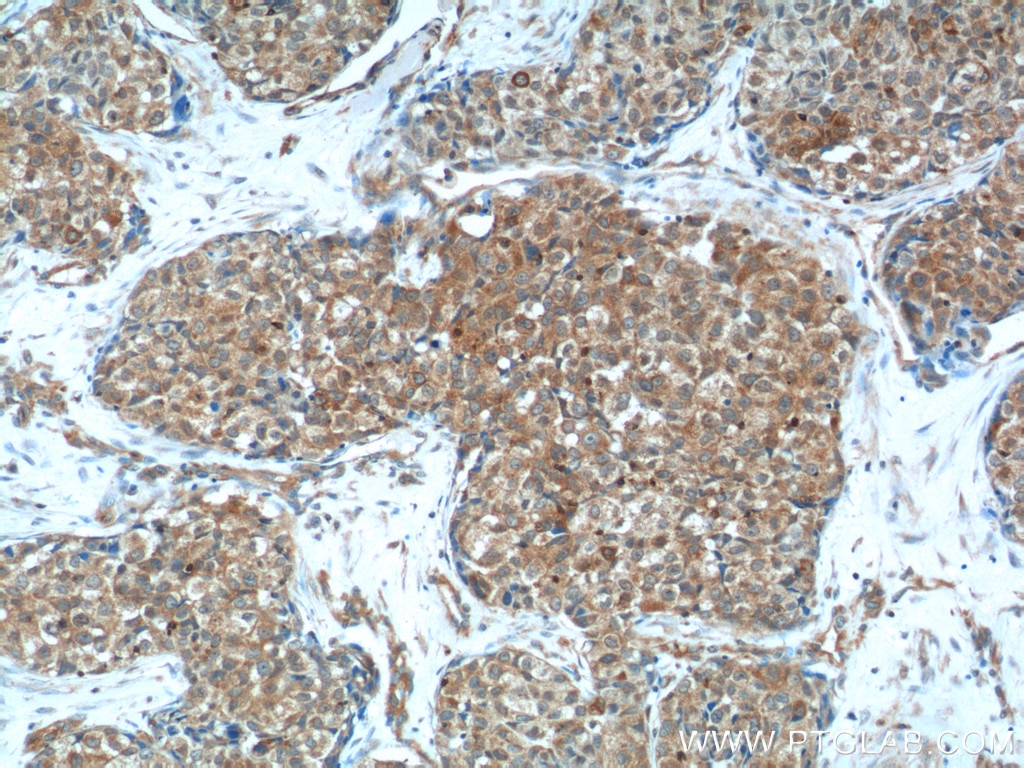 Immunohistochemistry (IHC) staining of human lung cancer tissue using cIAP2 Polyclonal antibody (24304-1-AP)