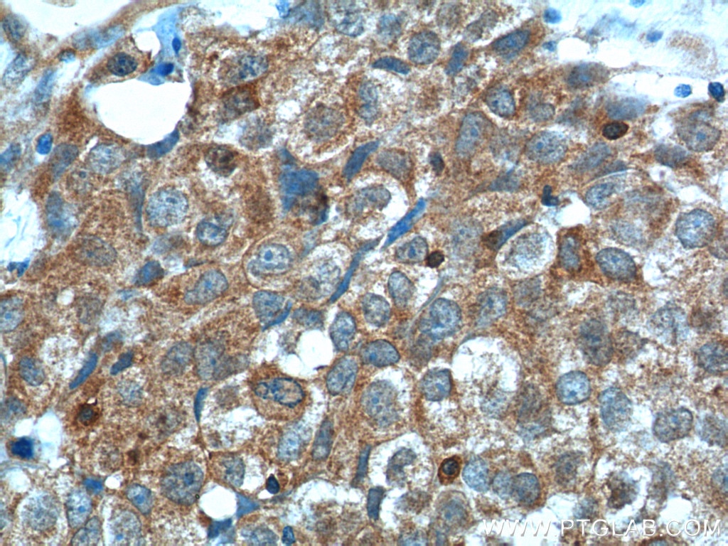 IHC staining of human lung cancer using 24304-1-AP