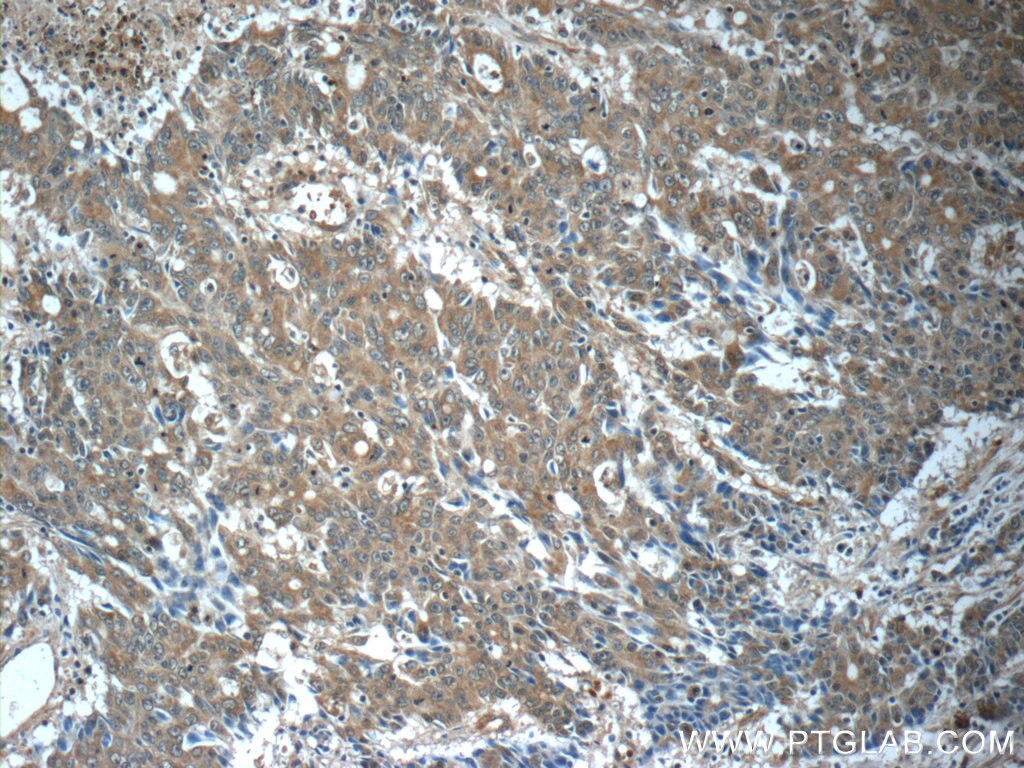 Immunohistochemistry (IHC) staining of human colon cancer tissue using SURVIVIN-Specific Polyclonal antibody (19119-1-AP)