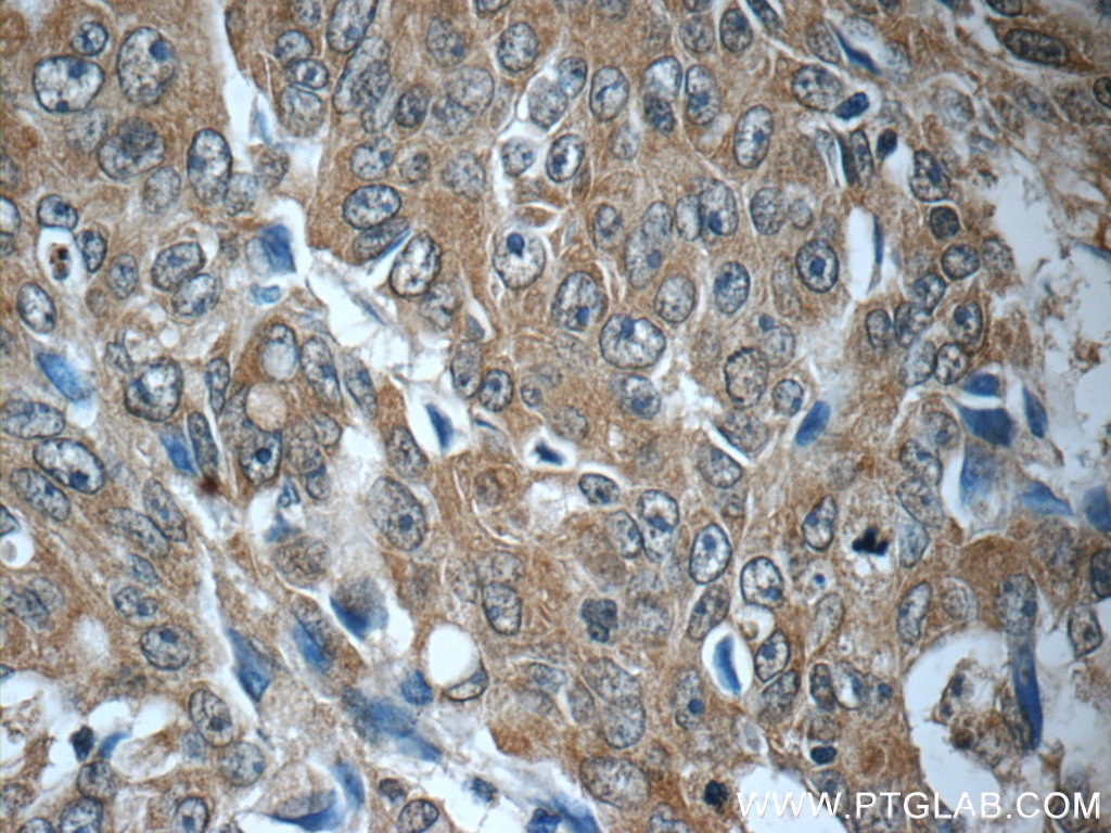 IHC staining of human colon cancer using 19119-1-AP