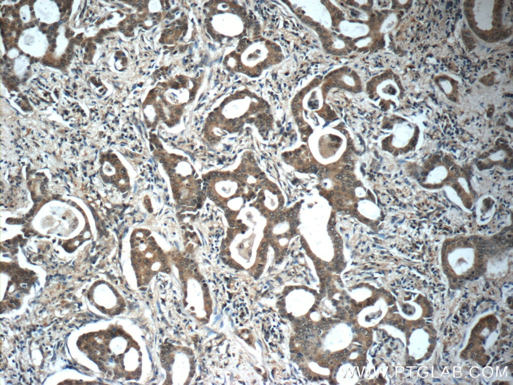 Immunohistochemistry (IHC) staining of human lung cancer tissue using SURVIVIN-Specific Polyclonal antibody (19119-1-AP)