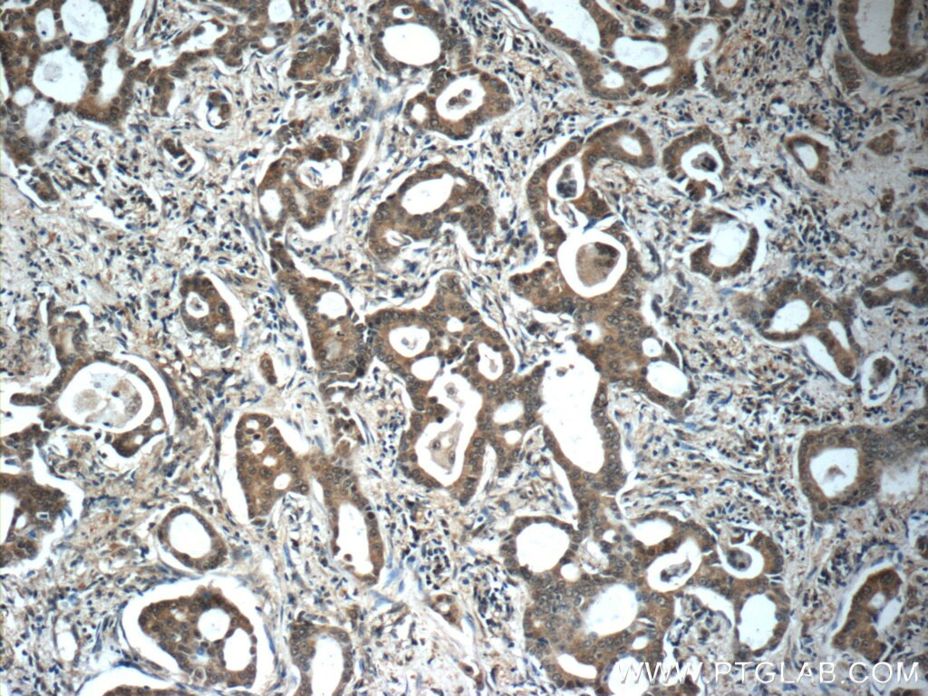 IHC staining of human lung cancer using 19119-1-AP