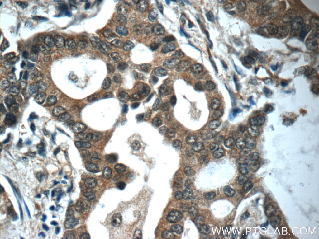 Immunohistochemistry (IHC) staining of human lung cancer tissue using SURVIVIN-Specific Polyclonal antibody (19119-1-AP)