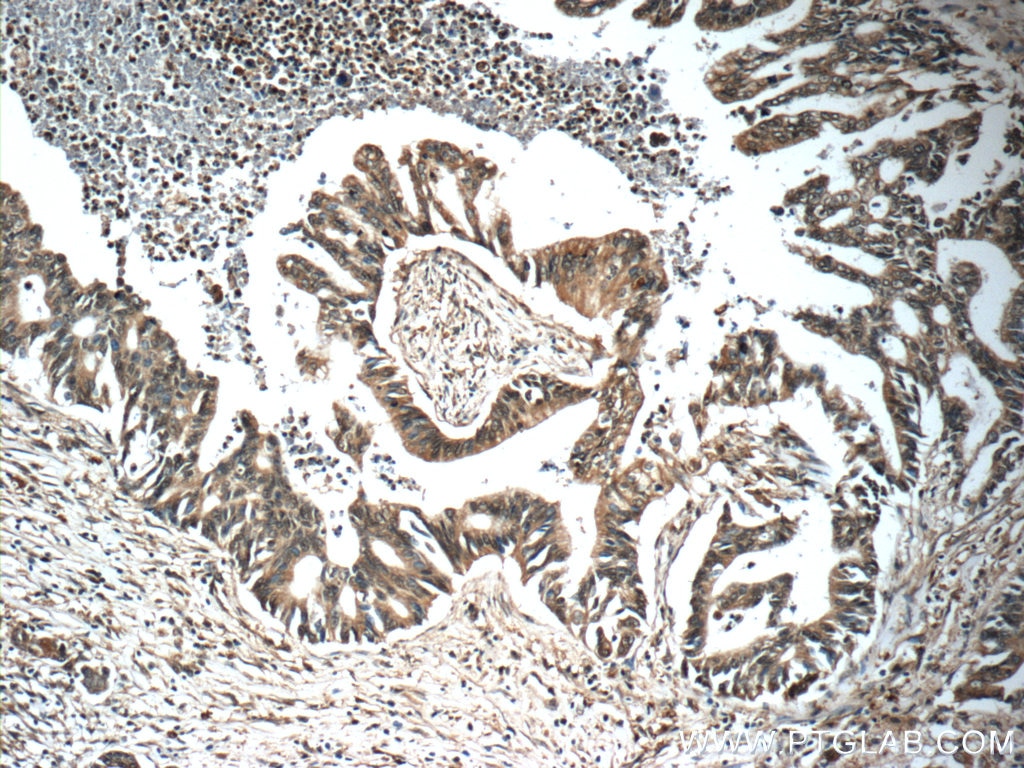 Immunohistochemistry (IHC) staining of human pancreas cancer tissue using SURVIVIN-Specific Polyclonal antibody (19119-1-AP)