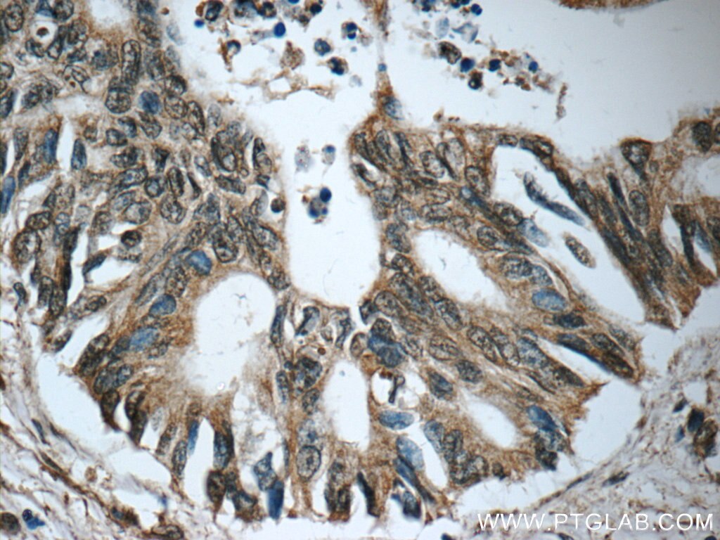 Immunohistochemistry (IHC) staining of human pancreas cancer tissue using SURVIVIN-Specific Polyclonal antibody (19119-1-AP)