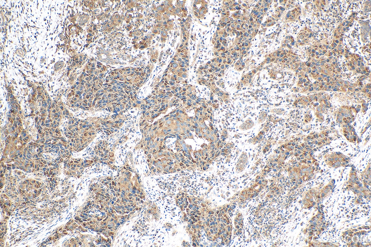 Immunohistochemistry (IHC) staining of human breast cancer tissue using BIRC6 Polyclonal antibody (29760-1-AP)