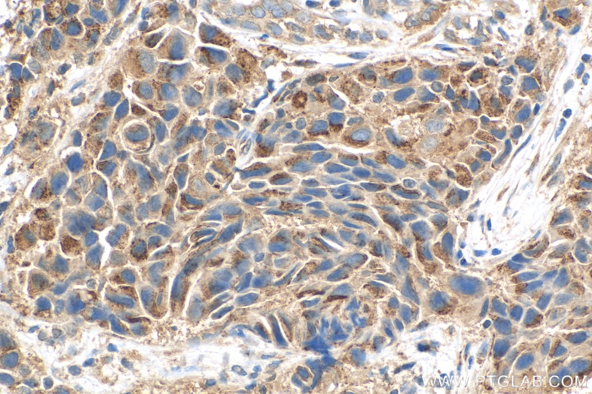 Immunohistochemistry (IHC) staining of human breast cancer tissue using BIRC6 Polyclonal antibody (29760-1-AP)