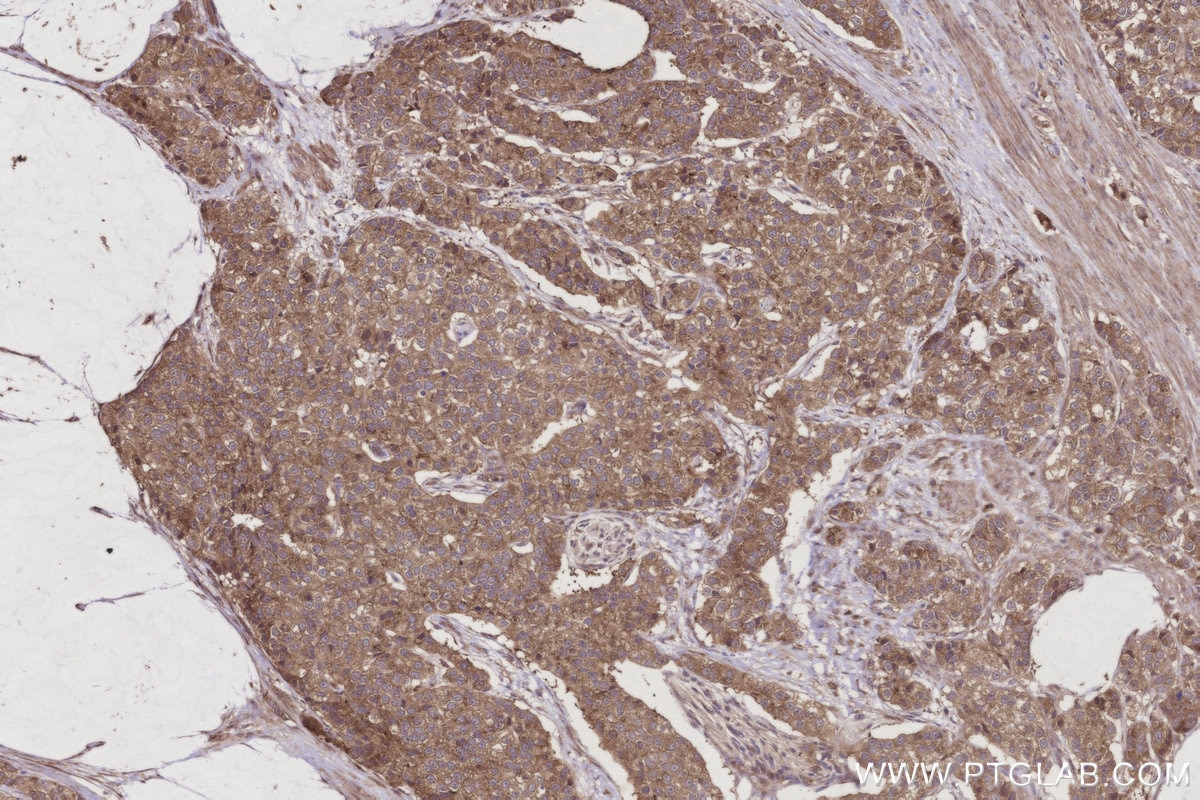 IHC staining of human stomach cancer using 29760-1-AP Immunohistochemistry (IHC) staining of human stomach cancer tissue using BIRC6 Polyclonal antibody (29760-1-AP)