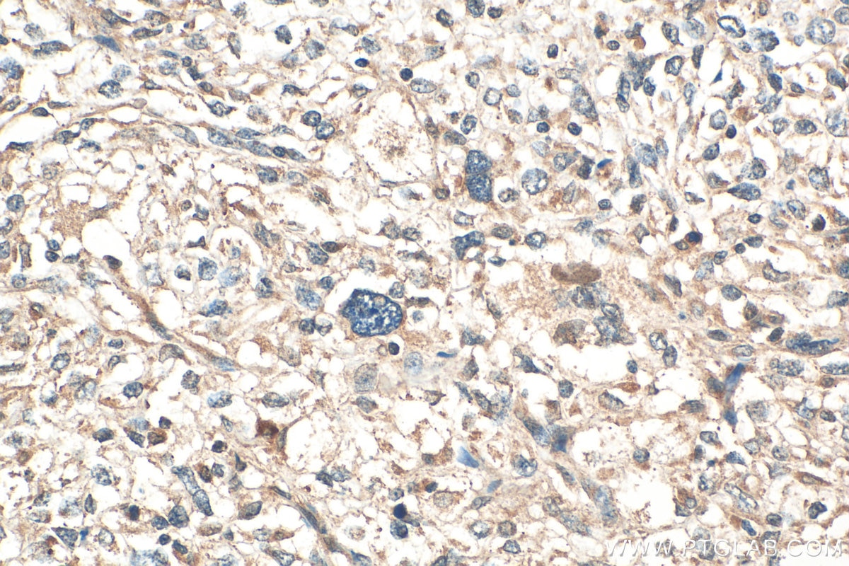 Immunohistochemistry (IHC) staining of human pancreas cancer tissue using BIVM Polyclonal antibody (25432-1-AP)