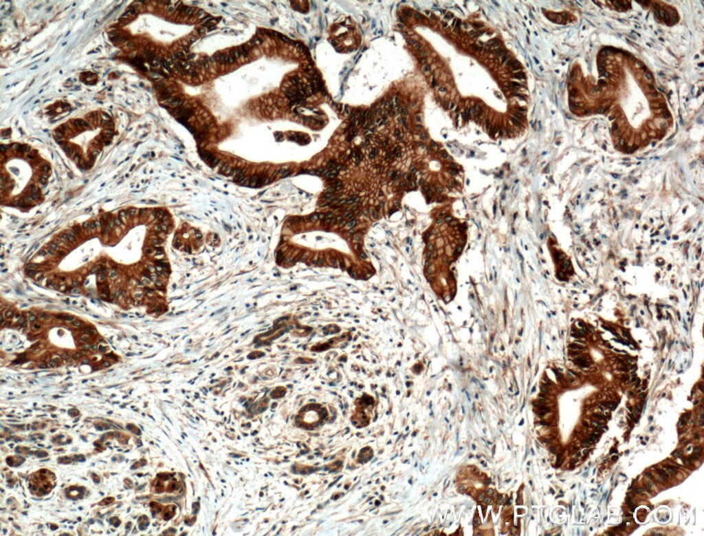 Immunohistochemistry (IHC) staining of human pancreas cancer tissue using BLK Polyclonal antibody (10510-1-AP)