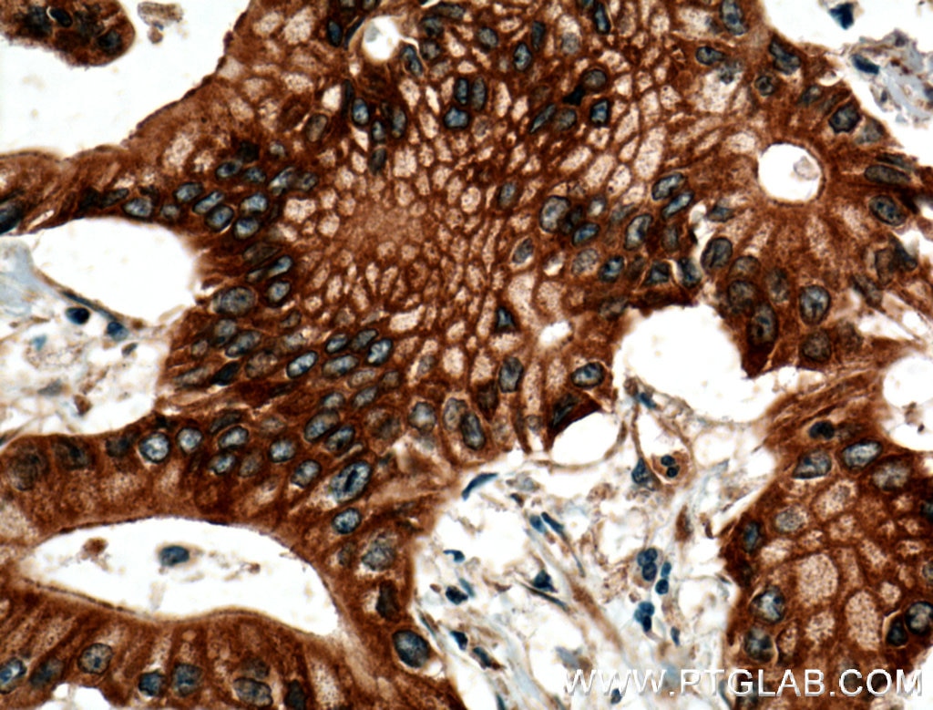 Immunohistochemistry (IHC) staining of human pancreas cancer tissue using BLK Polyclonal antibody (10510-1-AP)