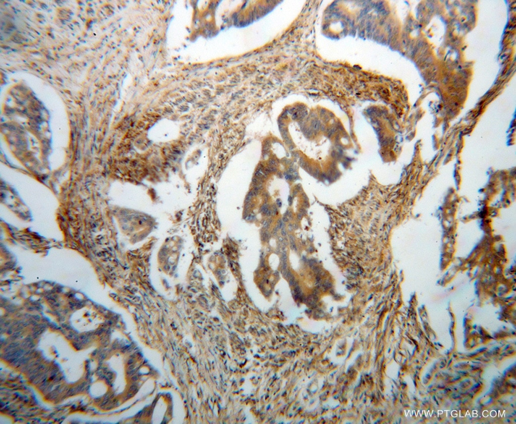 Immunohistochemistry (IHC) staining of human colon cancer tissue using BLMH Polyclonal antibody (14941-1-AP)