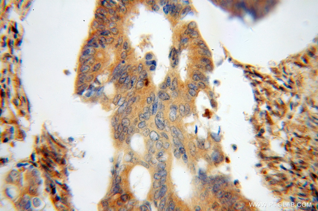 Immunohistochemistry (IHC) staining of human colon cancer tissue using BLMH Polyclonal antibody (14941-1-AP)