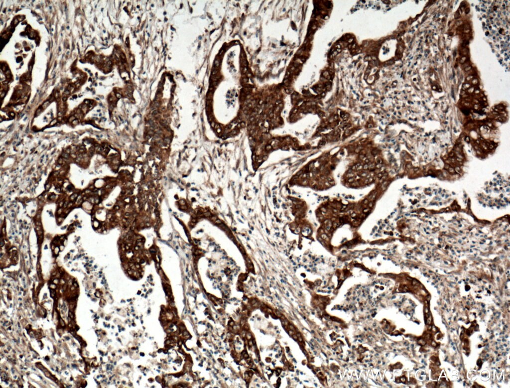 Immunohistochemistry (IHC) staining of human pancreas cancer tissue using BLNK Polyclonal antibody (10855-1-AP)