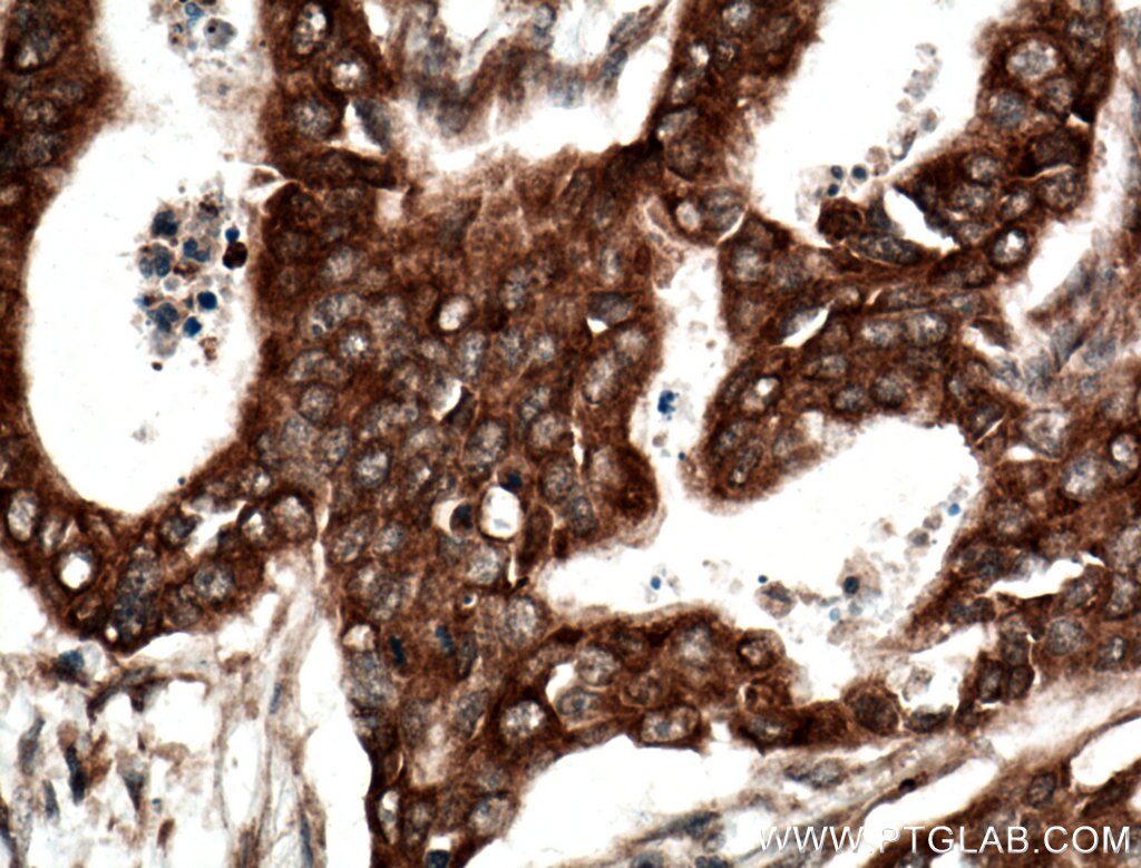 Immunohistochemistry (IHC) staining of human pancreas cancer tissue using BLNK Polyclonal antibody (10855-1-AP)