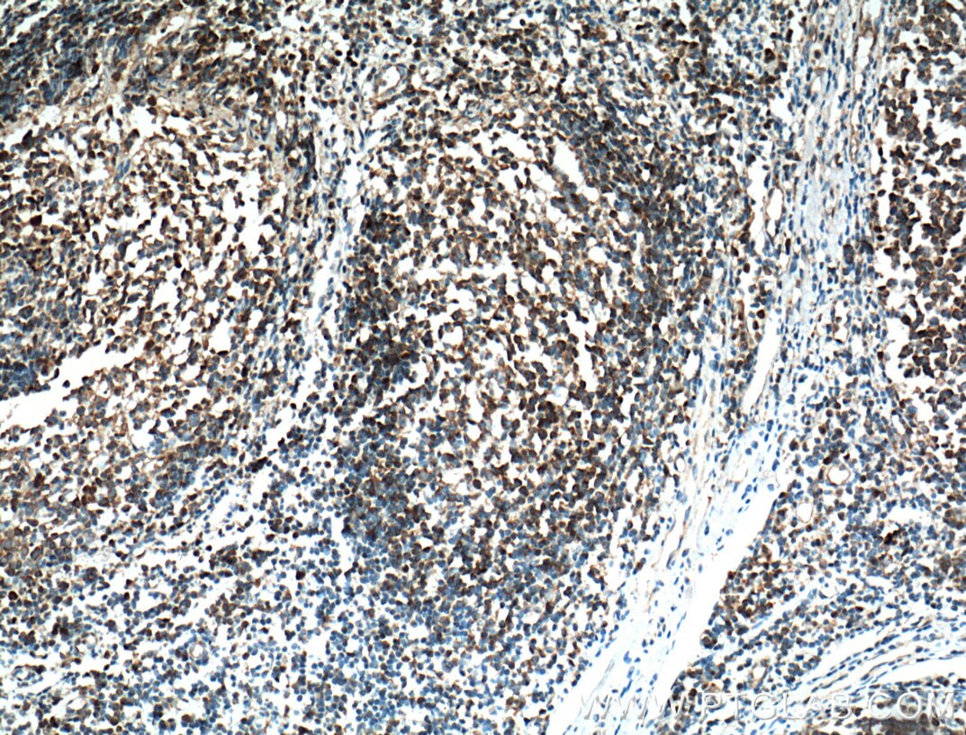 Immunohistochemistry (IHC) staining of human tonsillitis tissue using BLNK Polyclonal antibody (10855-1-AP)