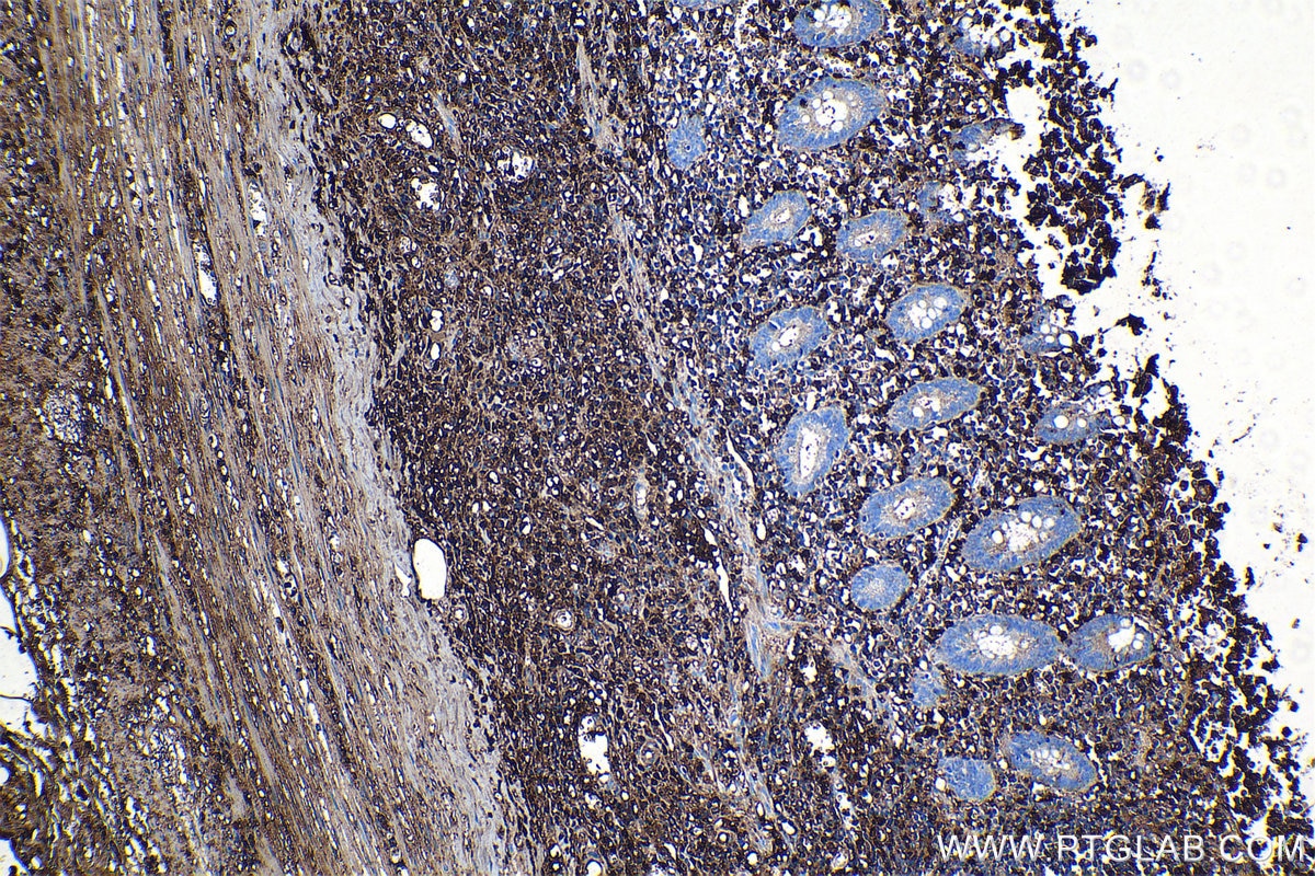 Immunohistochemistry (IHC) staining of human appendicitis tissue using BLNK Monoclonal antibody (66953-1-Ig)