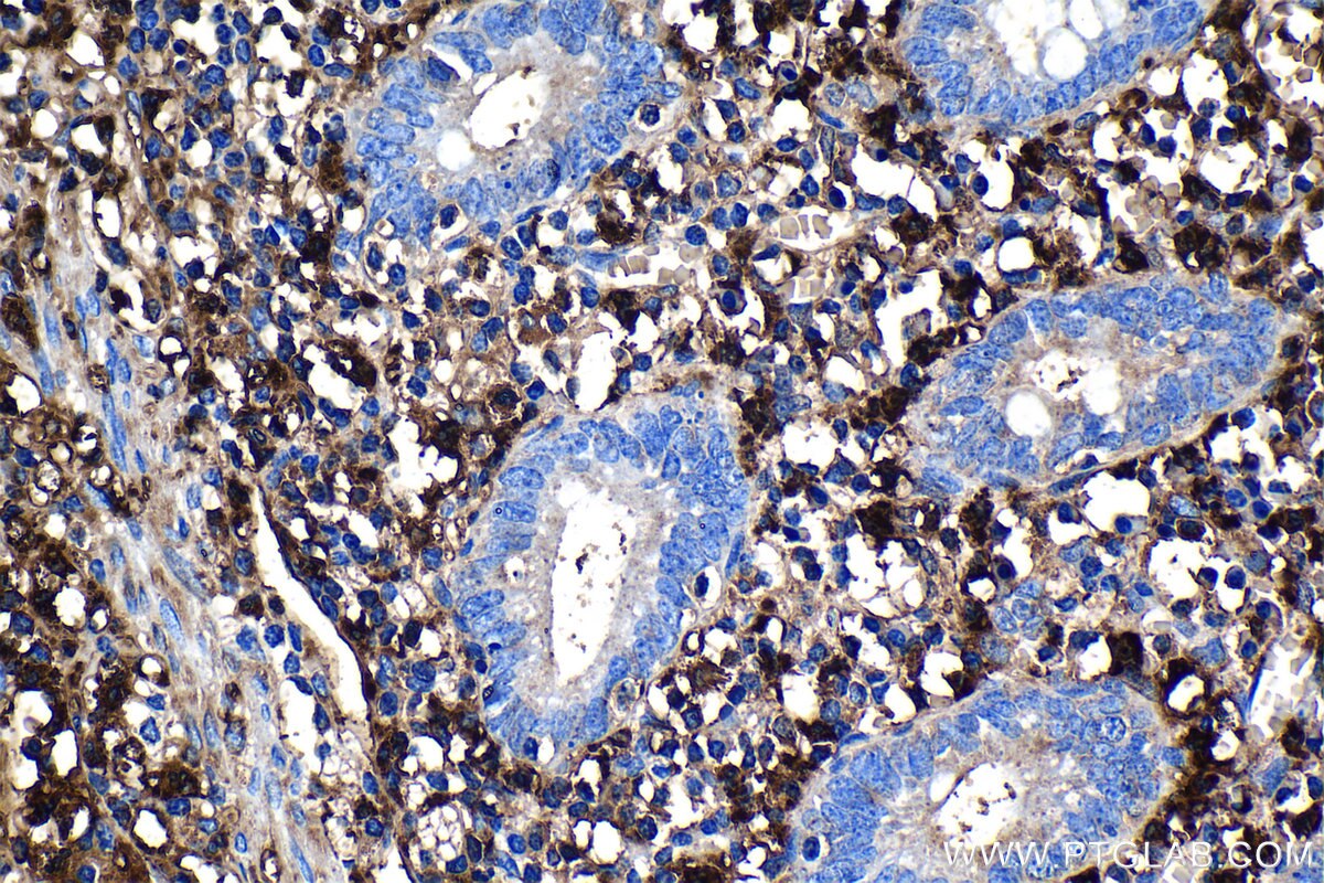 Immunohistochemistry (IHC) staining of human appendicitis tissue using BLNK Monoclonal antibody (66953-1-Ig)