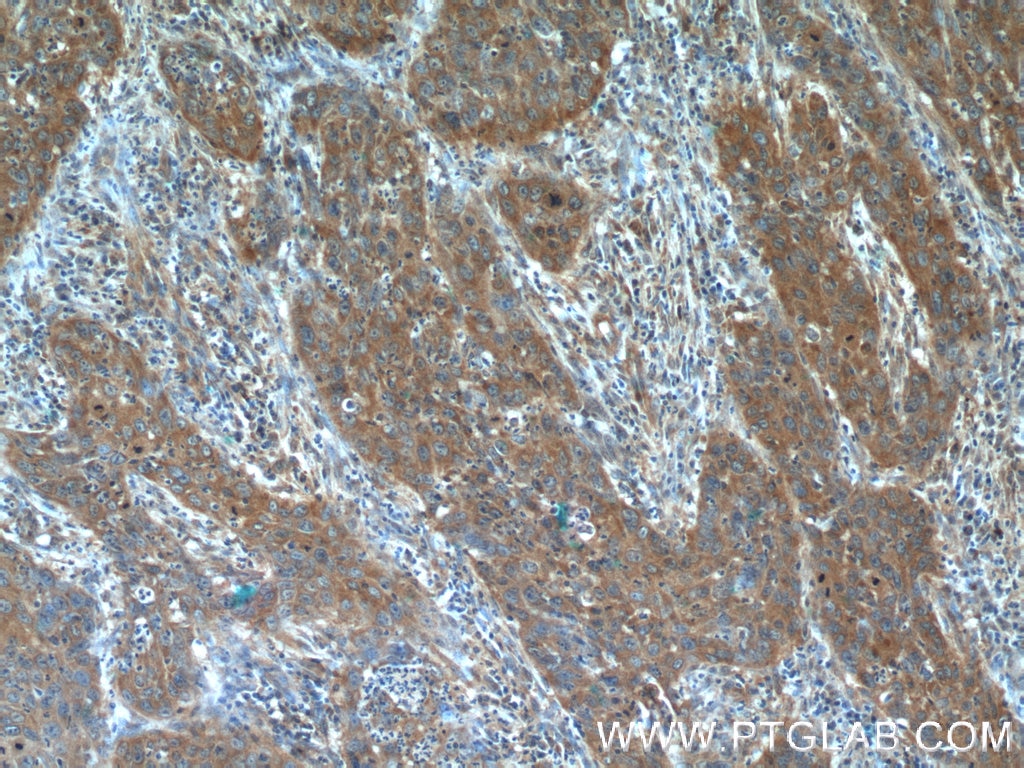 Immunohistochemistry (IHC) staining of human cervical cancer tissue using BLOC1S3 Polyclonal antibody (25722-1-AP)