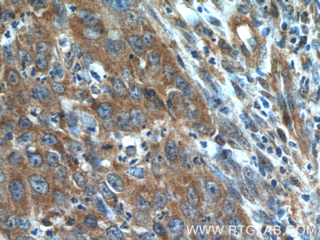 Immunohistochemistry (IHC) staining of human cervical cancer tissue using BLOC1S3 Polyclonal antibody (25722-1-AP)