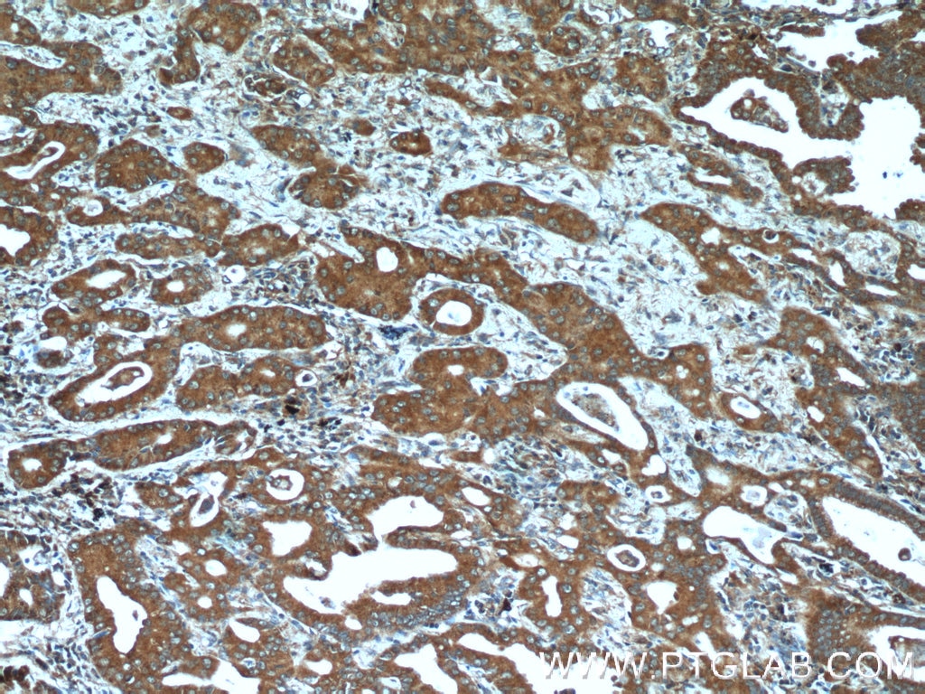 Immunohistochemistry (IHC) staining of human lung cancer tissue using BLOC1S3 Polyclonal antibody (25722-1-AP)
