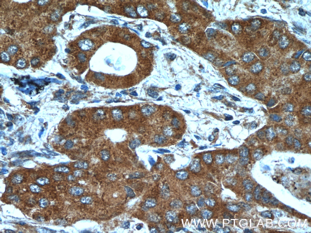 Immunohistochemistry (IHC) staining of human lung cancer tissue using BLOC1S3 Polyclonal antibody (25722-1-AP)