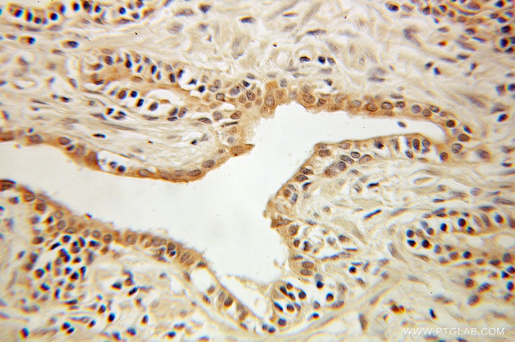 Immunohistochemistry (IHC) staining of human prostate cancer tissue using BLVRA Polyclonal antibody (10775-1-AP)