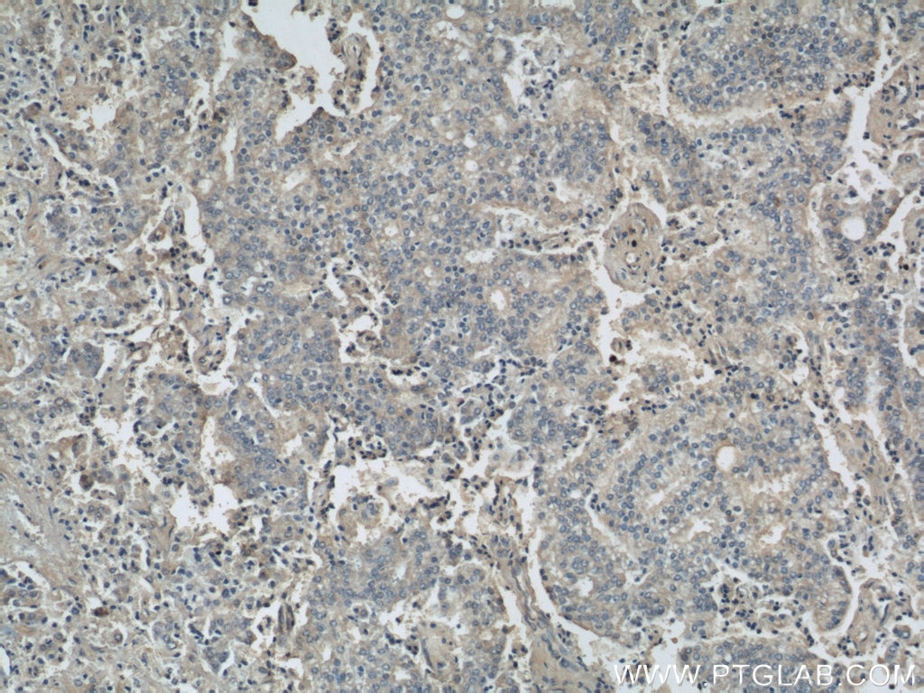 IHC staining of human prostate cancer using 10775-1-AP