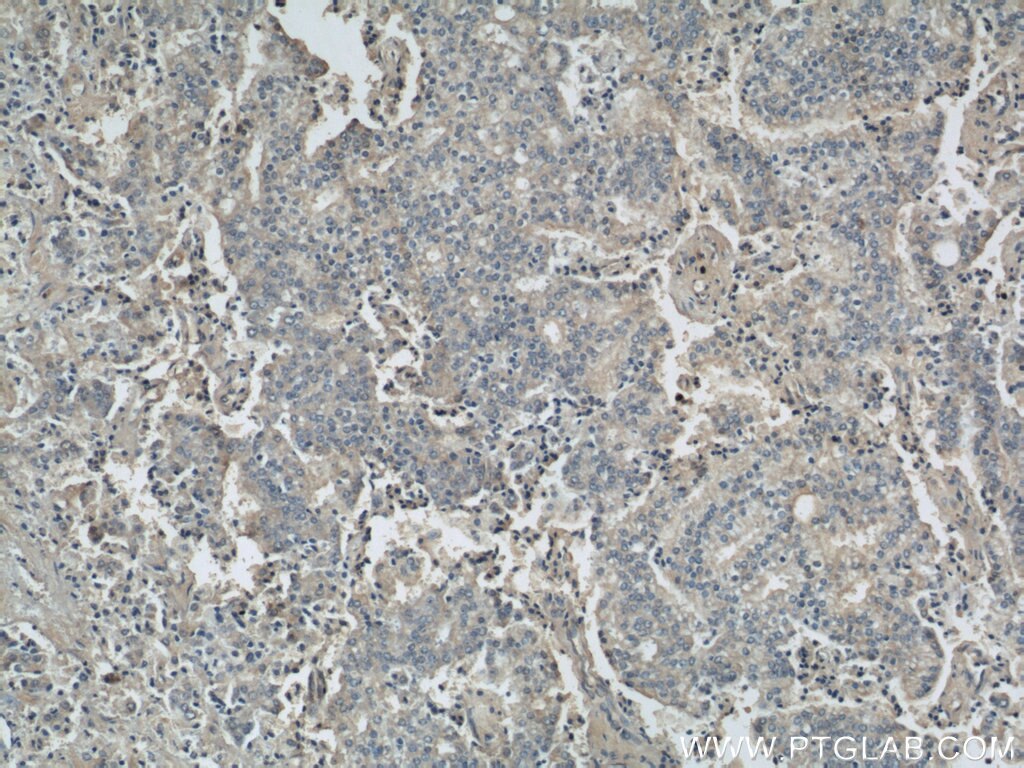 Immunohistochemistry (IHC) staining of human prostate cancer tissue using BLVRA Polyclonal antibody (10775-1-AP)