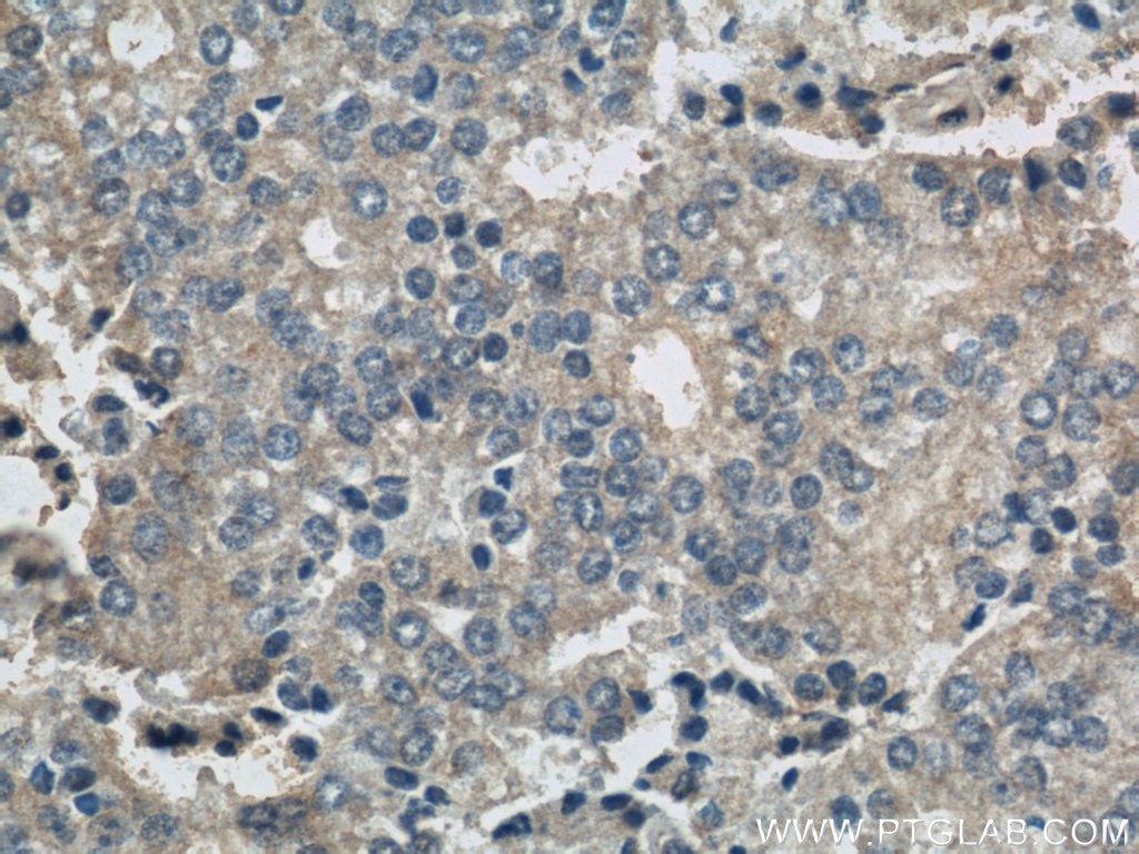 Immunohistochemistry (IHC) staining of human prostate cancer tissue using BLVRA Polyclonal antibody (10775-1-AP)