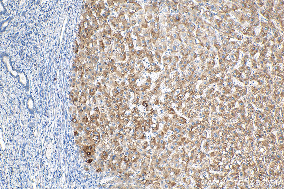 Immunohistochemistry (IHC) staining of human liver cancer tissue using BLZF1 Polyclonal antibody (16354-1-AP)
