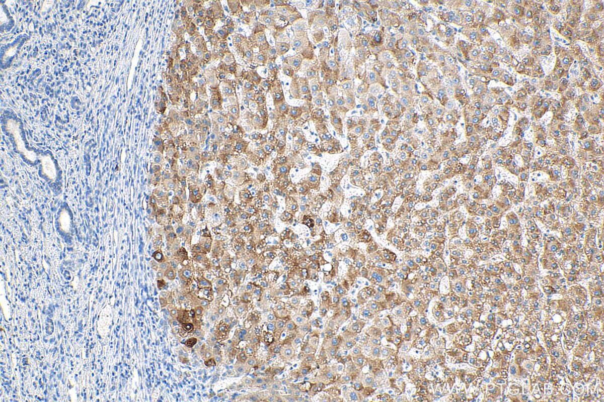 Immunohistochemistry (IHC) staining of human liver cancer tissue using BLZF1 Polyclonal antibody (16354-1-AP)