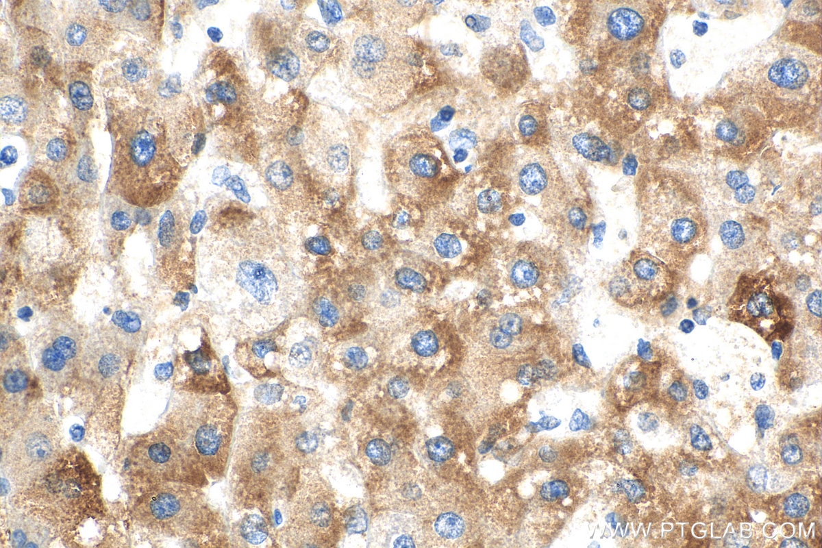 Immunohistochemistry (IHC) staining of human liver cancer tissue using BLZF1 Polyclonal antibody (16354-1-AP)