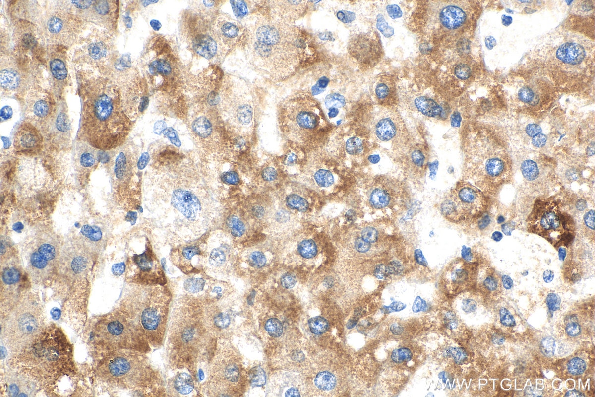Immunohistochemistry (IHC) staining of human liver cancer tissue using BLZF1 Polyclonal antibody (16354-1-AP)