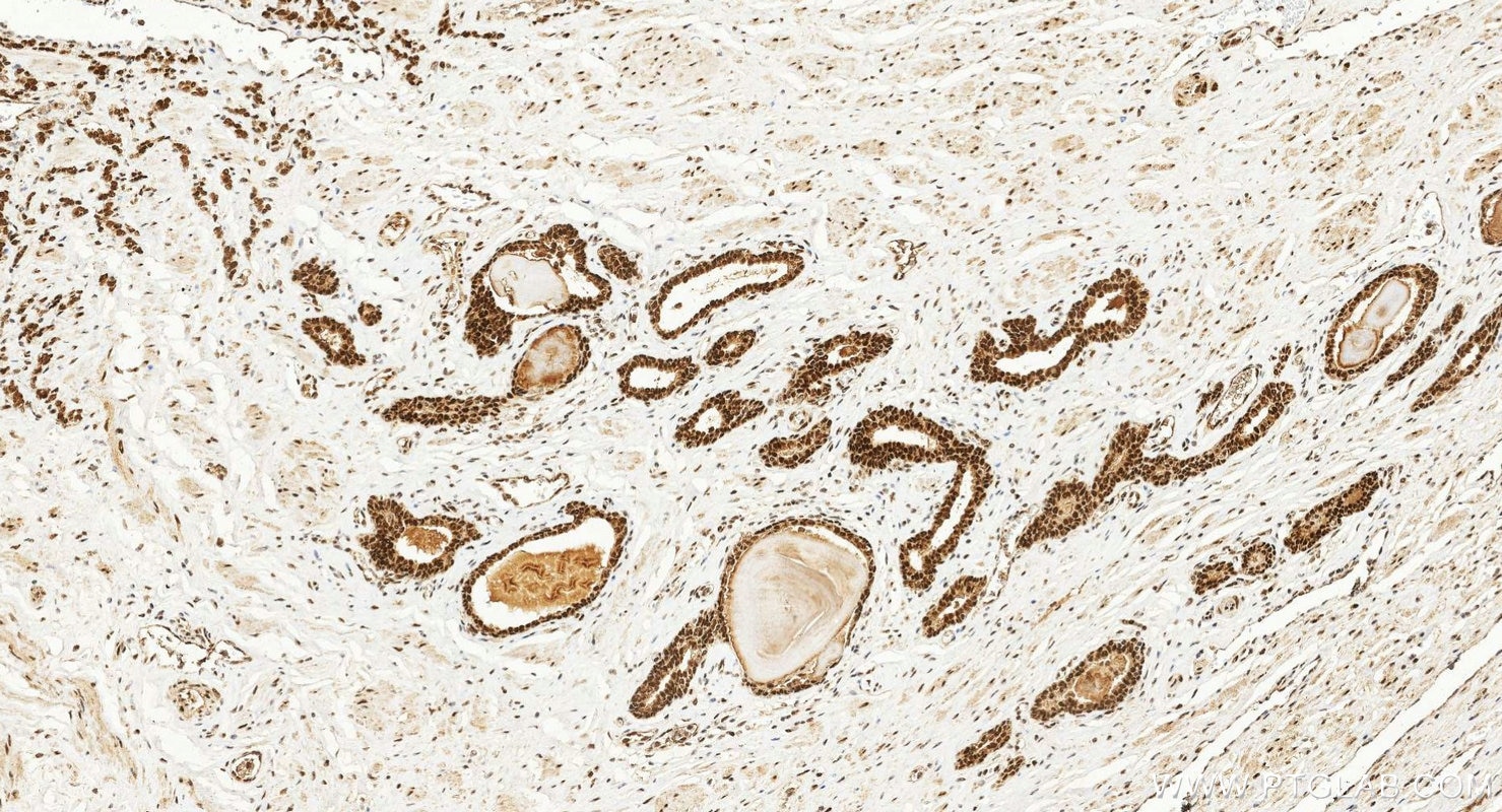 IHC staining of human prostate cancer using 10832-1-AP Immunohistochemistry (IHC) staining of human prostate cancer tissue using BMI1 Polyclonal antibody (10832-1-AP)