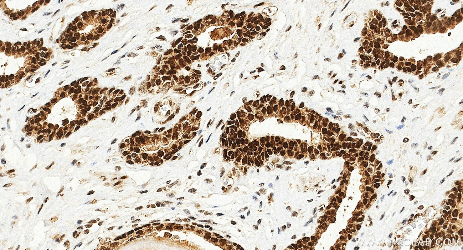IHC staining of human prostate cancer using 10832-1-AP Immunohistochemistry (IHC) staining of human prostate cancer tissue using BMI1 Polyclonal antibody (10832-1-AP)