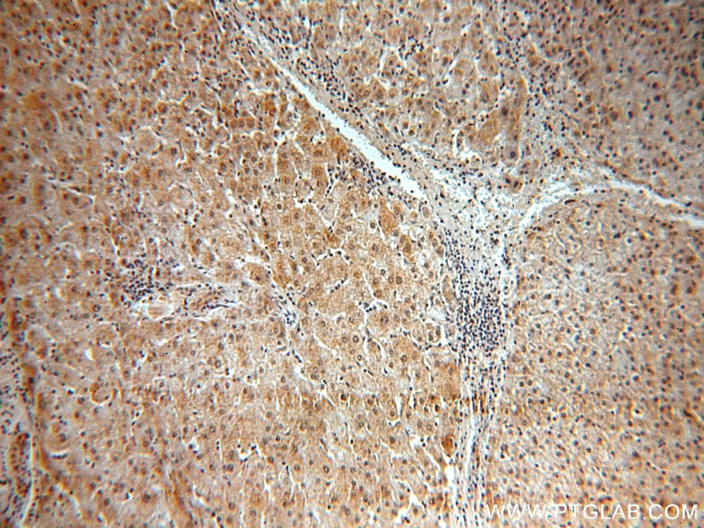Immunohistochemistry (IHC) staining of human liver cancer tissue using BMI1 Polyclonal antibody (10832-1-AP)