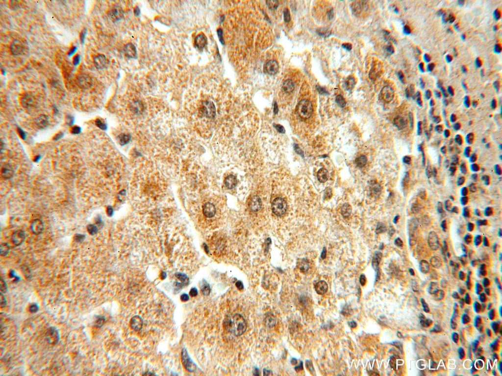 IHC staining of human liver cancer using 10832-1-AP