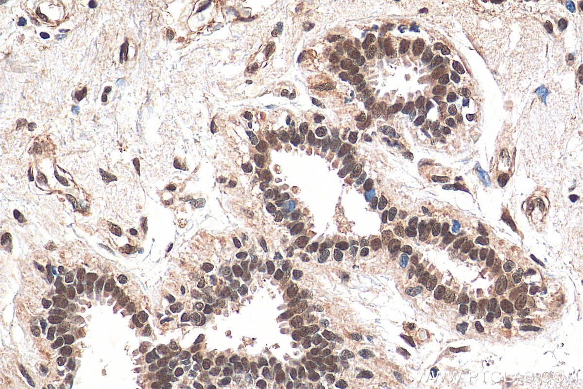Immunohistochemistry (IHC) staining of human breast cancer tissue using BMI1 Monoclonal antibody (66161-1-Ig)
