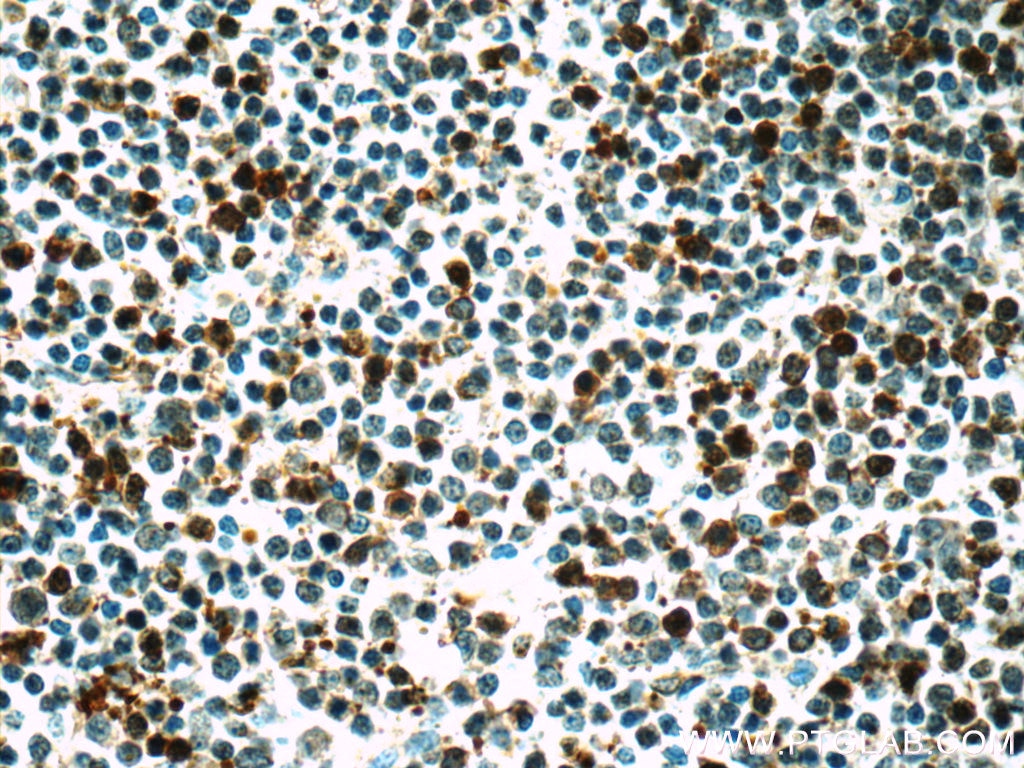 Immunohistochemistry (IHC) staining of human lymphoma tissue using BMI1 Monoclonal antibody (66161-1-Ig)