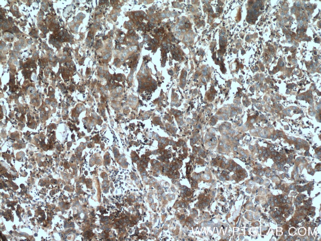 Immunohistochemistry (IHC) staining of human prostate cancer tissue using BMP15 Polyclonal antibody (18982-1-AP)