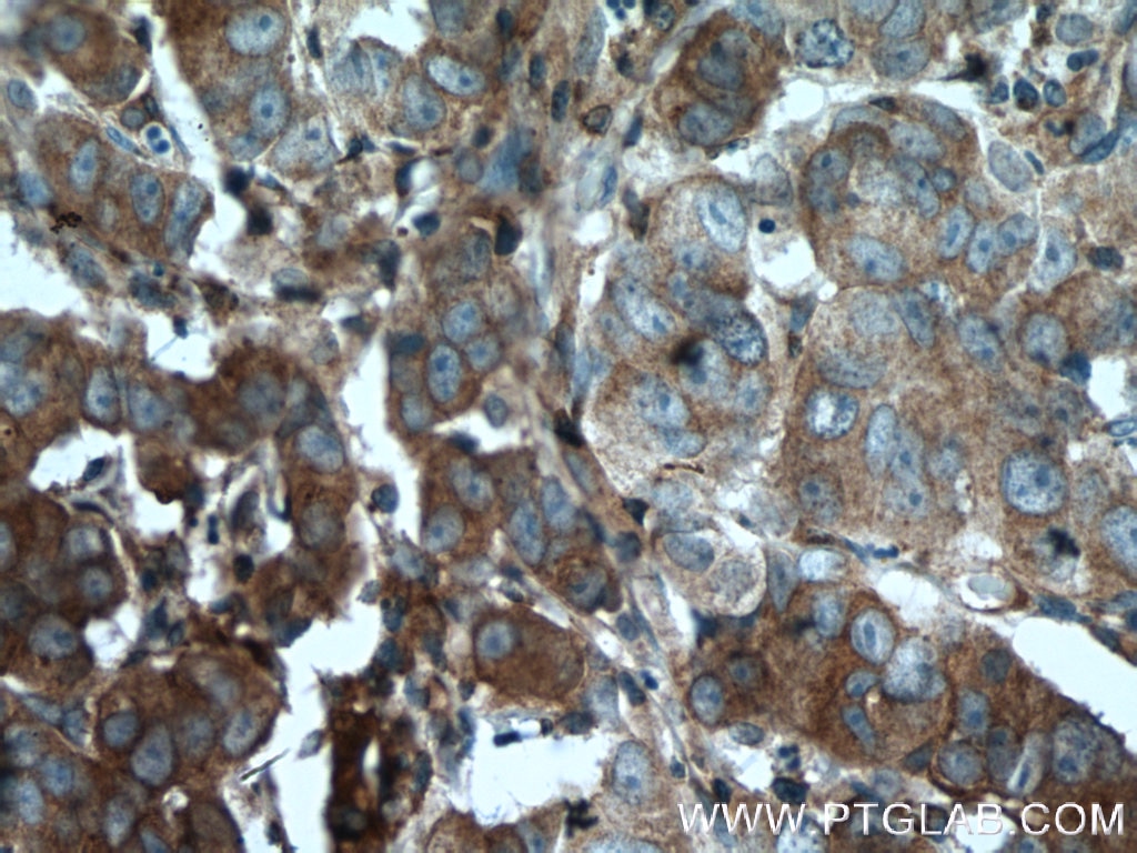 Immunohistochemistry (IHC) staining of human prostate cancer tissue using BMP15 Polyclonal antibody (18982-1-AP)