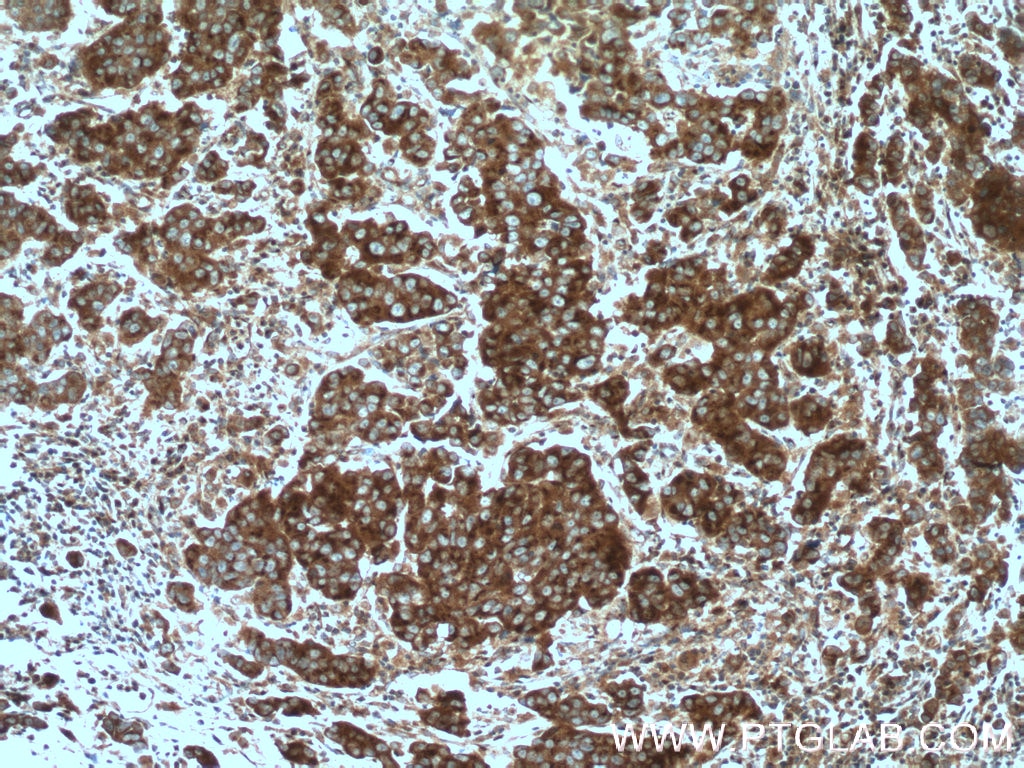 Immunohistochemistry (IHC) staining of human prostate cancer tissue using BMP15 Polyclonal antibody (18982-1-AP)