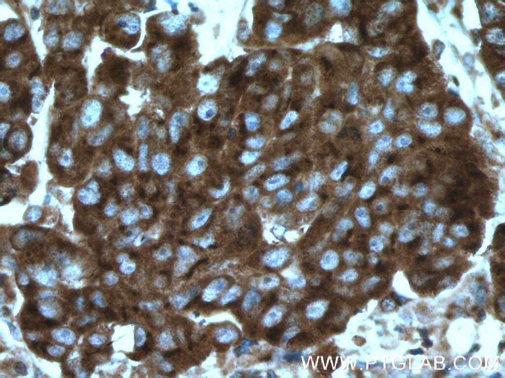 Immunohistochemistry (IHC) staining of human prostate cancer tissue using BMP15 Polyclonal antibody (18982-1-AP)