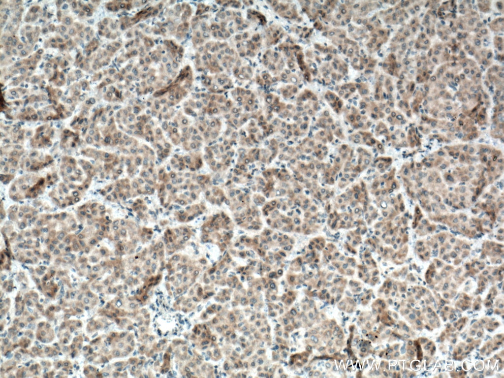 Immunohistochemistry (IHC) staining of human liver cancer tissue using BMP3 Polyclonal antibody (22188-1-AP)