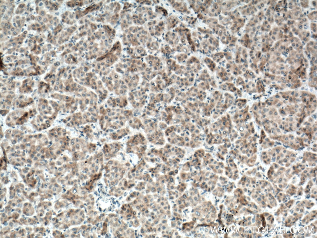 IHC staining of human liver cancer using 22188-1-AP