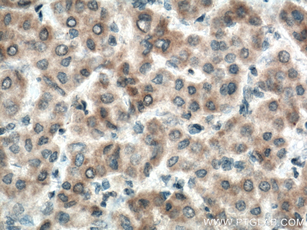 IHC staining of human liver cancer using 22188-1-AP
