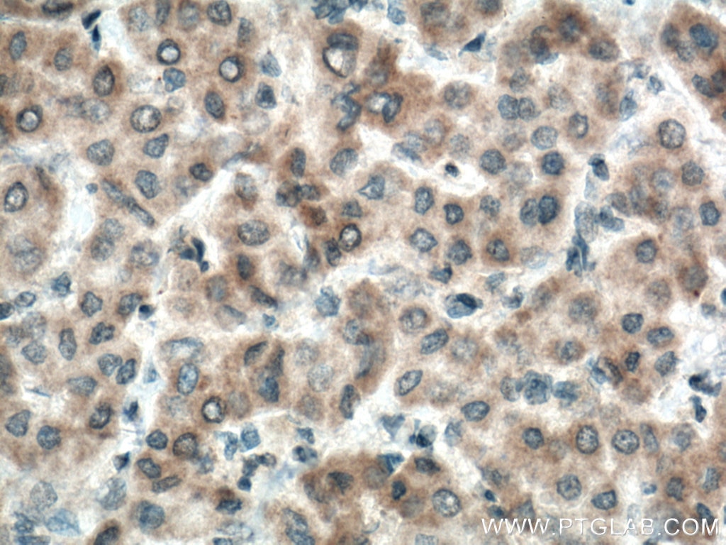 Immunohistochemistry (IHC) staining of human liver cancer tissue using BMP3 Polyclonal antibody (22188-1-AP)