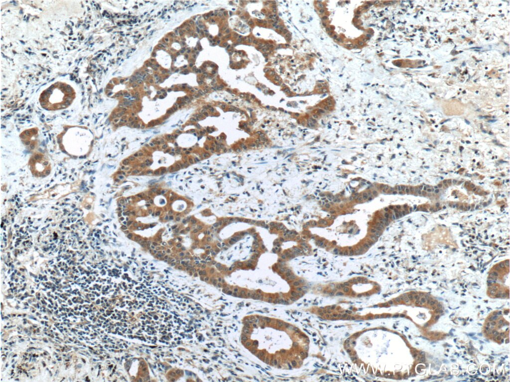 Immunohistochemistry (IHC) staining of human lung cancer tissue using BMP3 Polyclonal antibody (22188-1-AP)