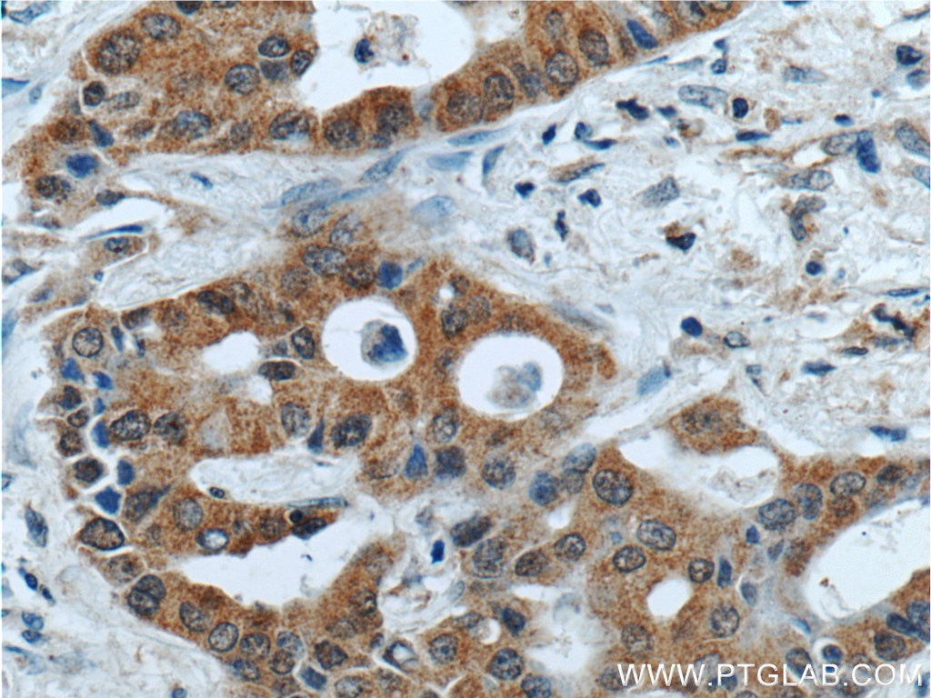 IHC staining of human lung cancer using 22188-1-AP